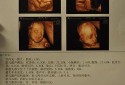 胎儿左心室有强光斑是什么意思啊？B超单是这样写的,胎儿左心室强光斑是什么意思