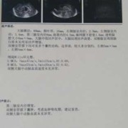 宝宝的室管膜下囊肿怎么样了,胎儿囊肿会自己消失吗吃什么消失的快