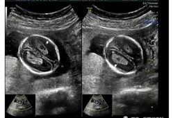4个月胎儿左侧脉络丛囊肿,脉络丛胎儿出生后遗症