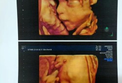 四维检查结果正常，但是宝宝脸上有东西是什么,四维图片胎儿全图