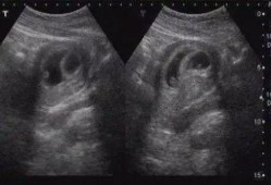 胎儿发育天数（为什么怀孕实际天数跟B超不一样）
