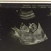 孕13周胎儿b超图（孕13周胎儿b超图片）