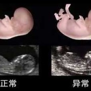 孕妇nf检查是什么意思,胎儿NF是什么意思