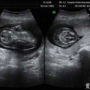 胎儿水囊瘤（12周+3胎儿水囊瘤，全身水肿，孩子还能不能要啦）