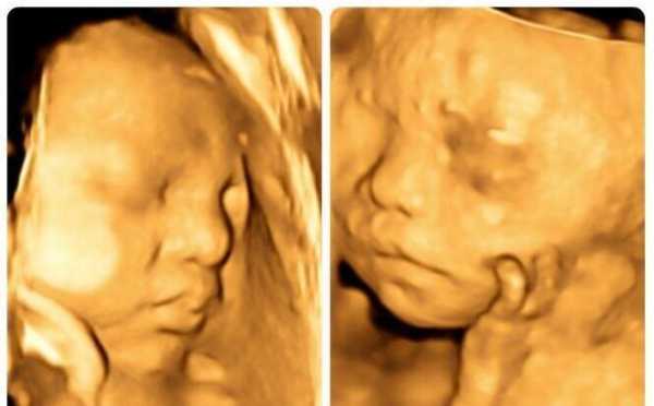 胎儿四维彩超图片（卸货的宝妈都来说说宝宝生下来和四维彩超照片像不像）  第2张