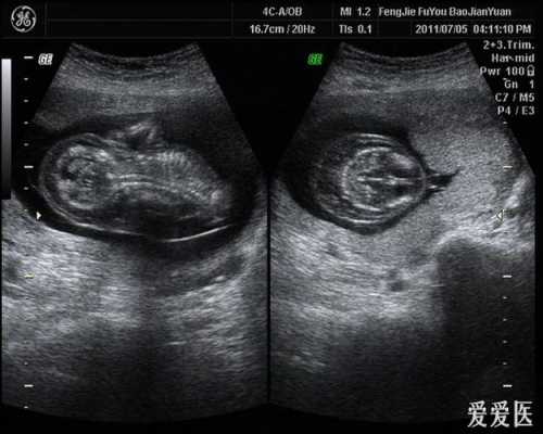 胎儿水囊瘤（12周+3胎儿水囊瘤，全身水肿，孩子还能不能要啦）  第1张