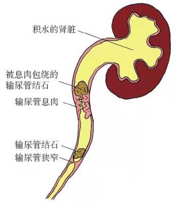 孕期输尿管结石（孕期输尿管结石怎么办）  第2张