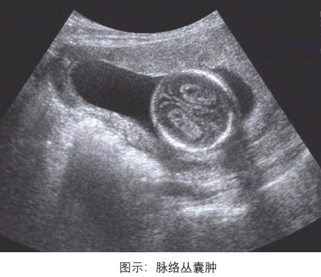 4个月胎儿左侧脉络丛囊肿,脉络丛胎儿出生后遗症  第2张