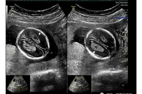 4个月胎儿左侧脉络丛囊肿,脉络丛胎儿出生后遗症  第1张
