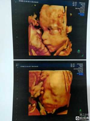 四维检查结果正常，但是宝宝脸上有东西是什么,四维图片胎儿全图  第1张
