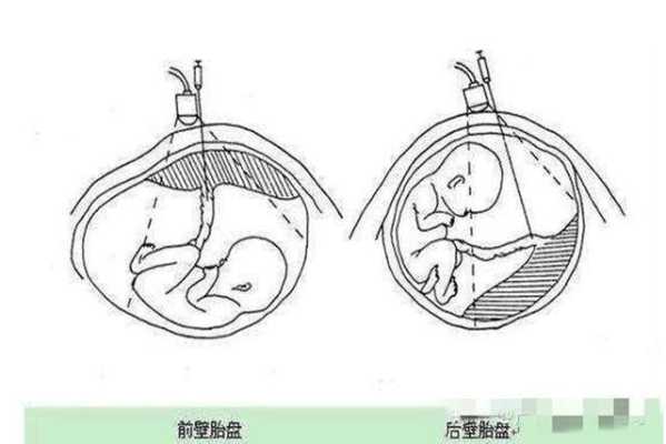 胎儿位于子宫前壁（胎儿位于子宫前壁和后壁有什么区别）  第1张