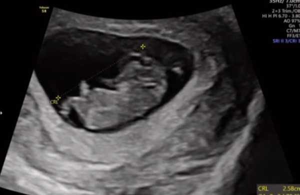 怀孕三个月了，b超显示宝宝偏小，以后会不会有影响,产检胎儿偏小一周怎么办  第1张