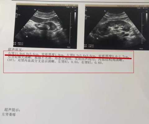 医生说可能胎儿右肾会偏小,应该怎么办,胎儿肾变小了是不是萎缩了  第3张