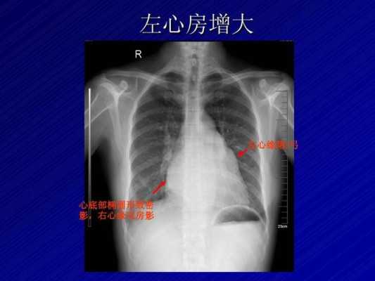 左心房增大严重吗,胎儿左心房偏大是什么原因  第1张