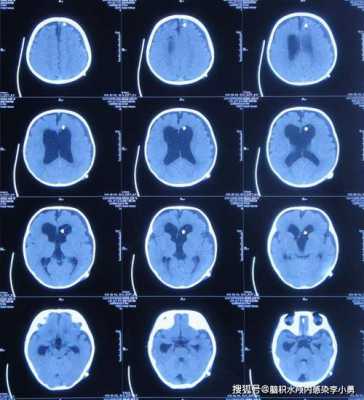 怀孕7个月胎儿脑部有积水怎么办,胎儿为什么会脑部积水呢  第1张