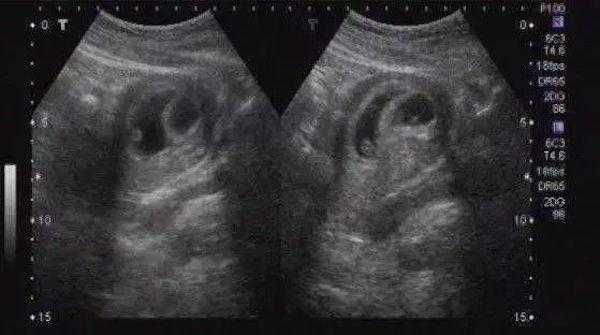 胎儿发育天数（为什么怀孕实际天数跟B超不一样）  第1张
