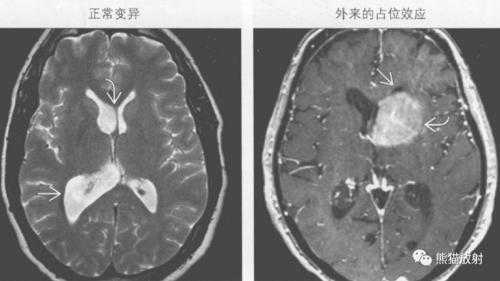 胎儿左右脑室不对称（胎儿左右脑室不对称）  第1张