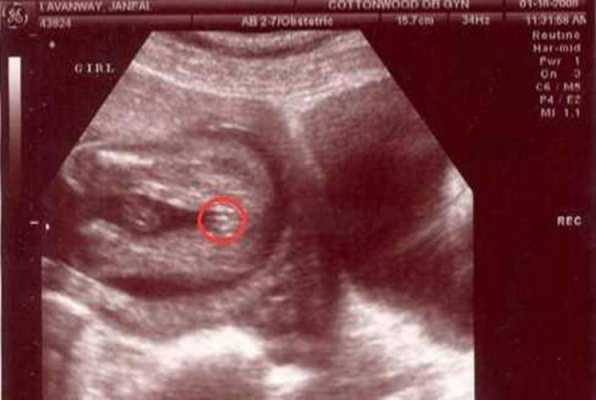 孕13周胎儿b超图（孕13周胎儿b超图片）  第1张