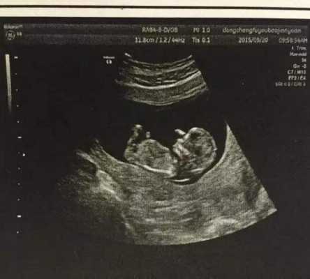 孕13周胎儿b超图（孕13周胎儿b超图片）  第2张